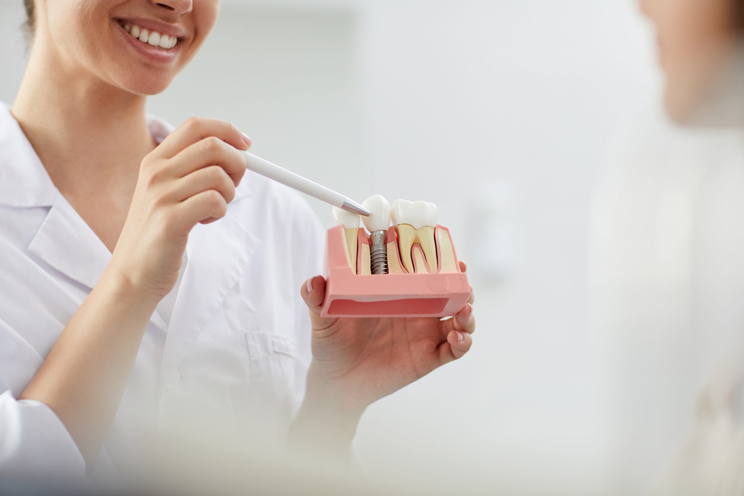Cuidados Colocación de un Implante Dental